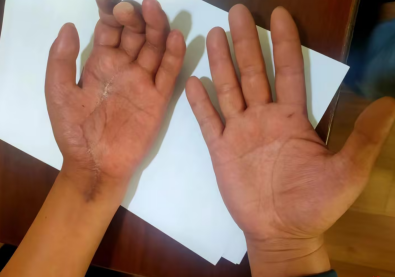 路见不平帮忙报警，男子手筋被砍断