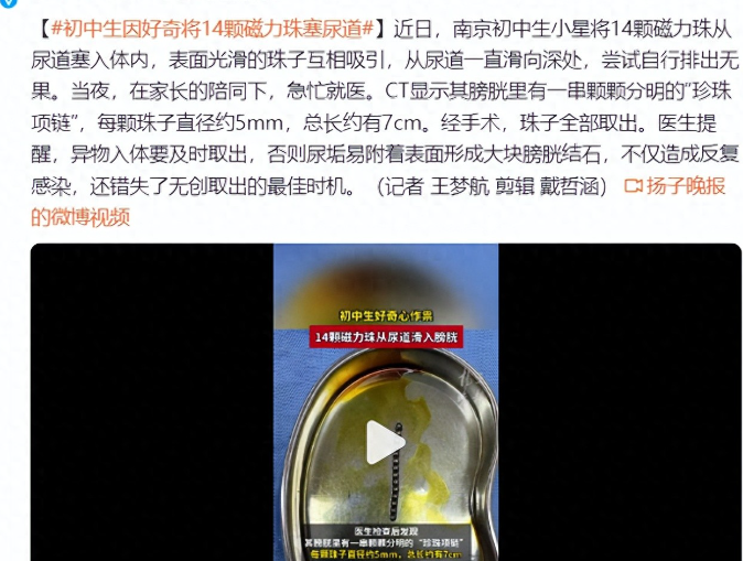 初中生因将14颗磁力珠塞尿道就医