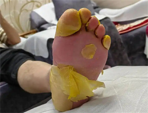 上海养生中心泡脚引起的脚气，谁得责任？