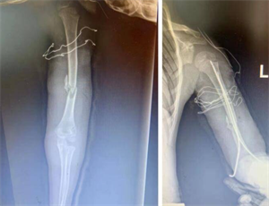 男子上海洗浴桑拿摔断手，商家拒绝赔偿